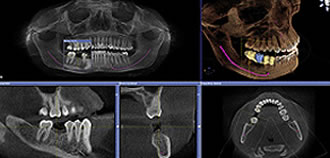 低被爆歯科用ＣＴ