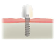 1本のインプラント