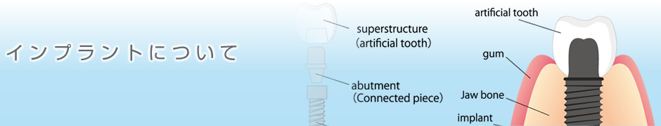 インプラントについて