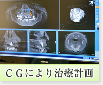 ＣＧにより治療計画